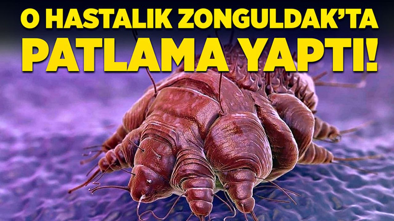 Dikkat: O hastalık Zonguldak’ta patlama yaptı!