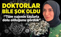 Vücudundan 287 tane taş çıkarıldı, doktorlar bile şok oldu