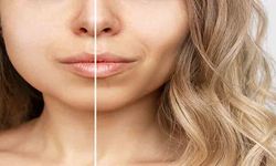 Bişektomi ile Yüzünüzde Genç ve Keskin Hatlar