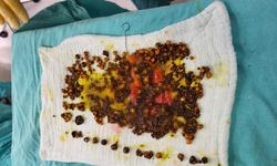 Karın Ağrısıyla Gitti, Safra Kesesi Taşla Dolu Çıktı