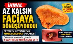Yutma güçlüğüyle gitti, yemek borusundan 4 santimlik kemik çıktı