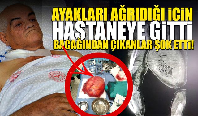 Ayakları ağrıyan hastanın uyluk kemiğinden 8 kilo 900 gram tümör çıktı!