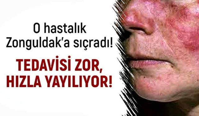 O hastalık Zonguldak’a sıçradı! Tedavisi zor, hızla yayılıyor!