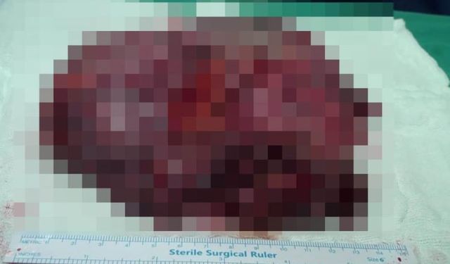 25 santimetrelik dev kist başarıyla alındı