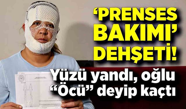 Güzellik Kabusa Döndü! Yüzü Yandı, Oğlu “Öcü” Dedi
