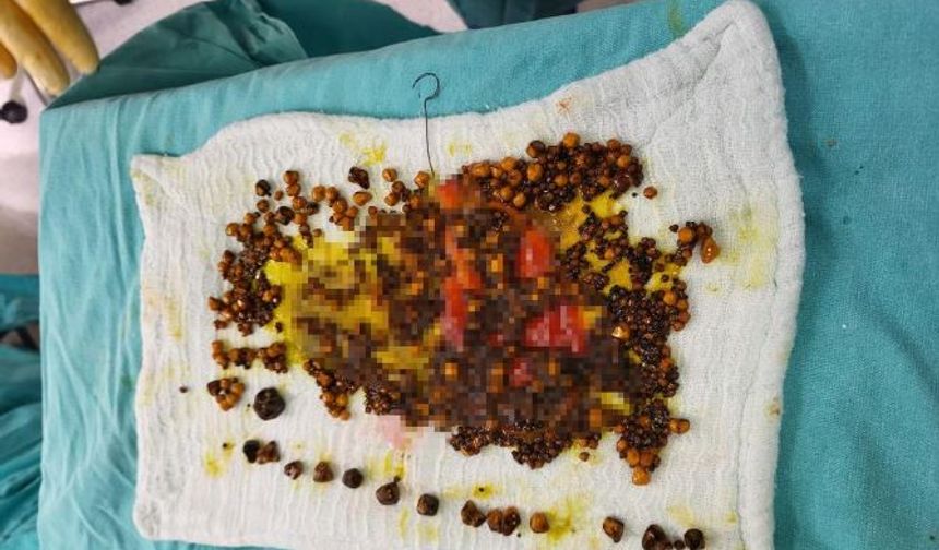 Karın Ağrısıyla Gitti, Safra Kesesi Taşla Dolu Çıktı