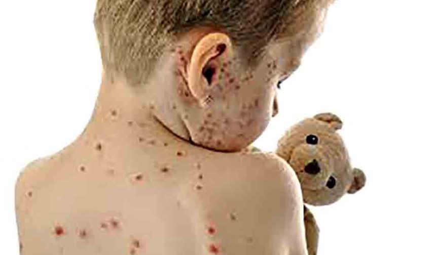 Kızamık vakaları yeniden yükseliyor