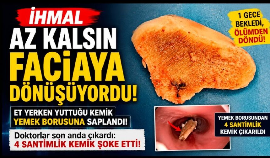 Yutma güçlüğüyle gitti, yemek borusundan 4 santimlik kemik çıktı