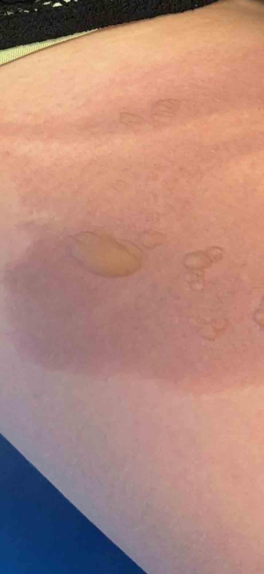 Sicak Su Torbasi Patlamasi (1)