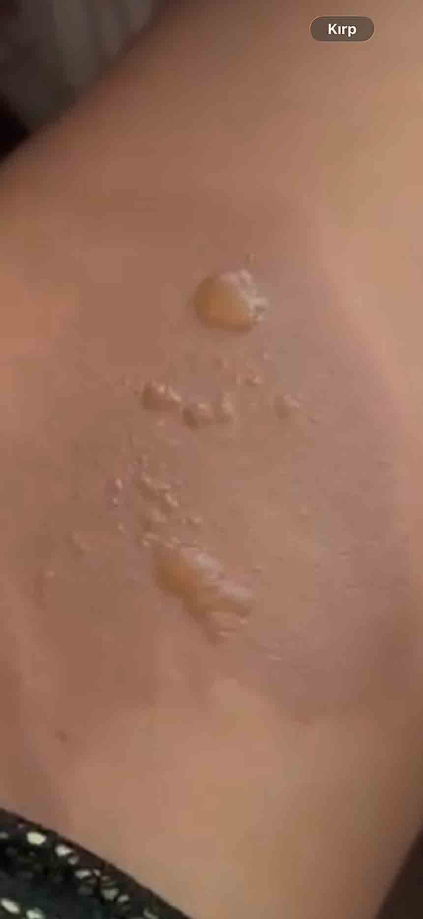 Sicak Su Torbasi Patlamasi (2)